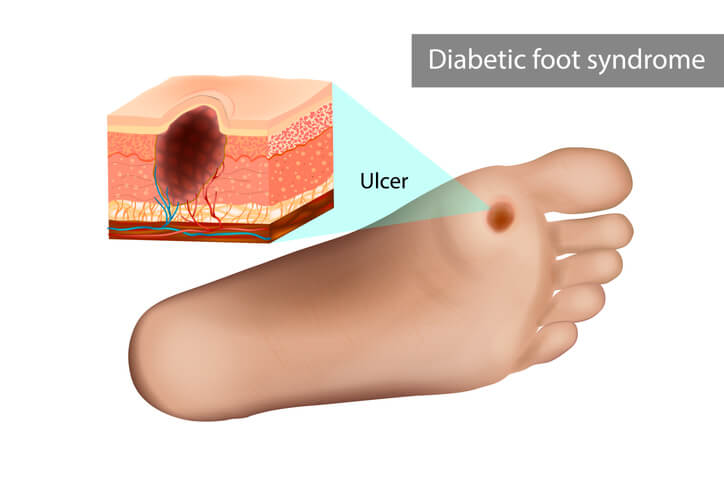 The Threat of MRSA in People With Diabetes & Foot Ulcers